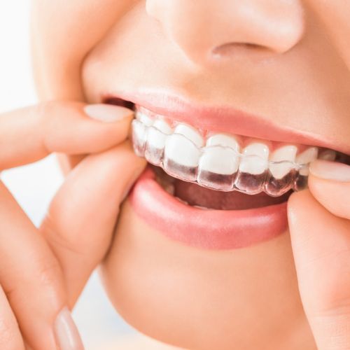 invisible-aligners