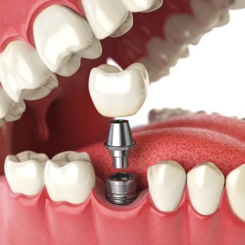implants