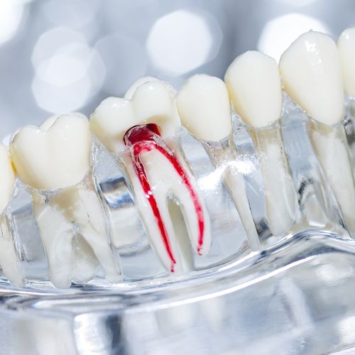 rootcanal-treatment