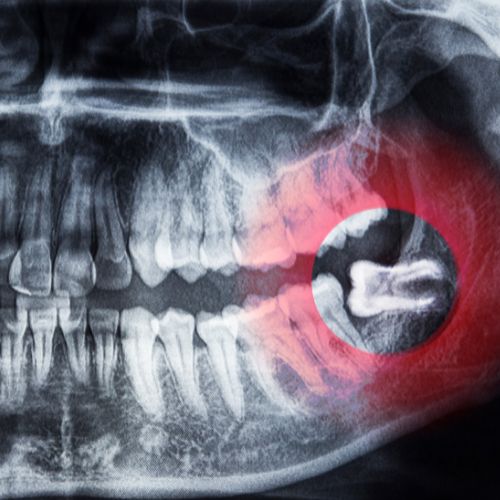 wisdom-teeth-removal